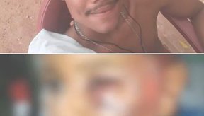 Imagem Menino de 4 anos é espancado e tem braço quebrado por Padrasto