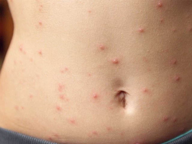 Imagem Piauí tem 8 casos suspeitos de sarampo